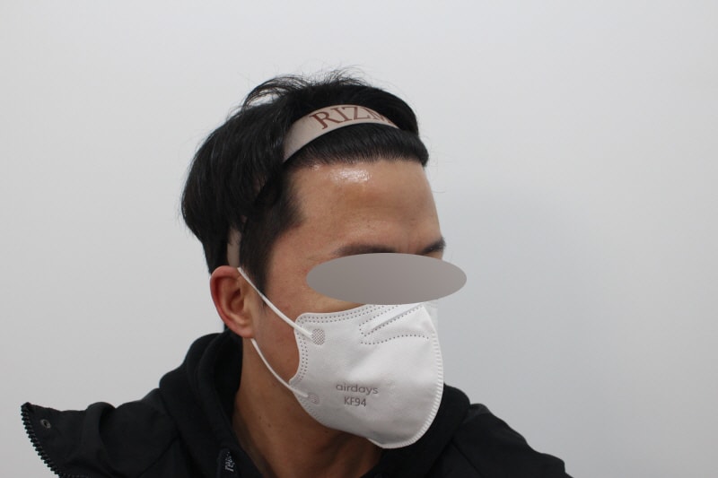 [크기변환]수술 1년차-밀도보강s.jpg