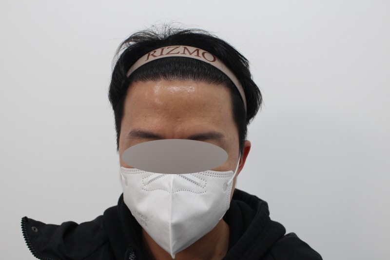 [크기변환]수술후-빽빽해진 밀도s.jpg