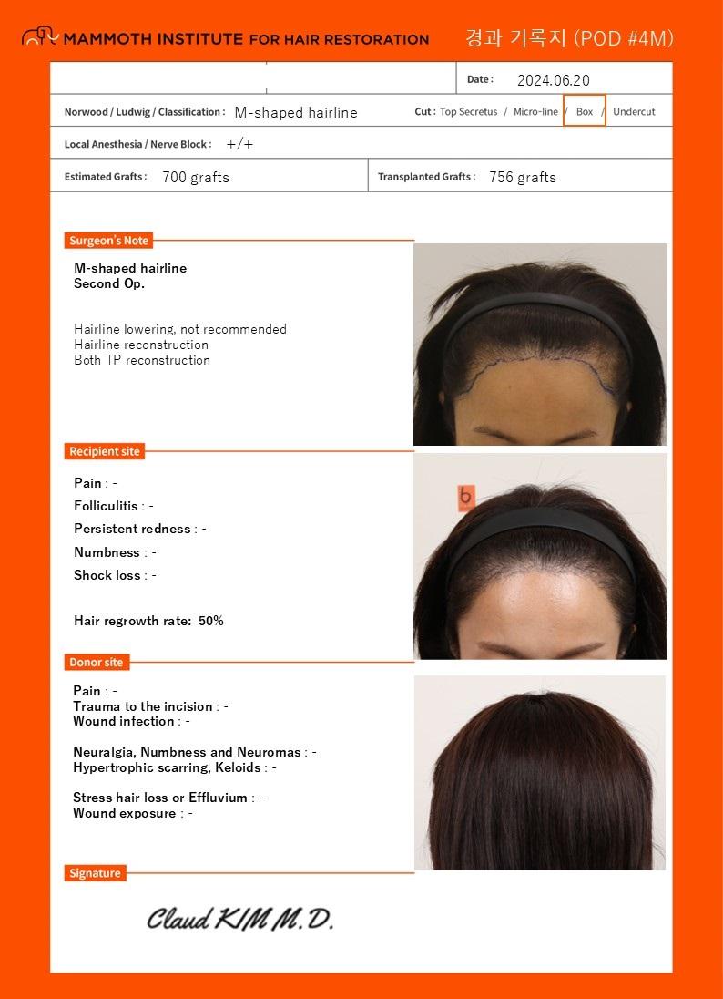 Busan Mammoth Hairline Hair Transplantation after 4 months