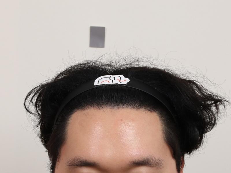 [Busan Mammoth] Review of M-shaped hair transplantation 10 months after scalp tattoo