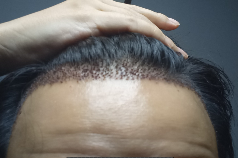 수술후정면사진6일경과.PNG