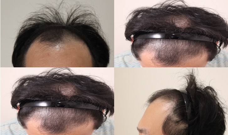 2200 Hair Orphanoid Non-Cutting Hair Transplantation Review
