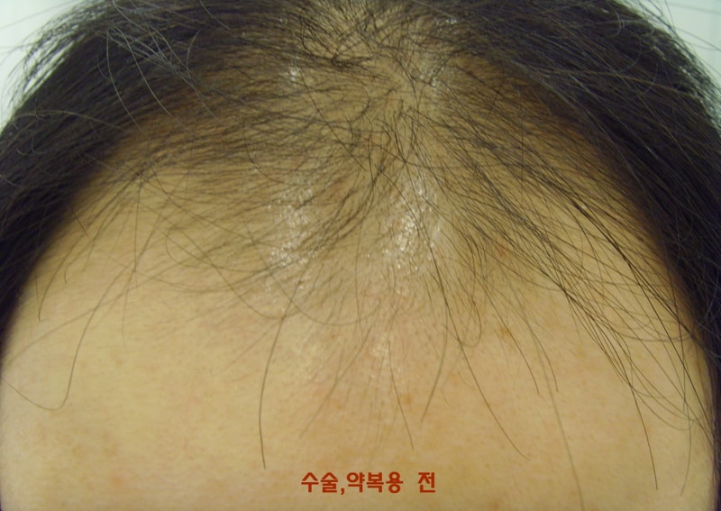 크기변환_꾸미기_수술전.JPG
