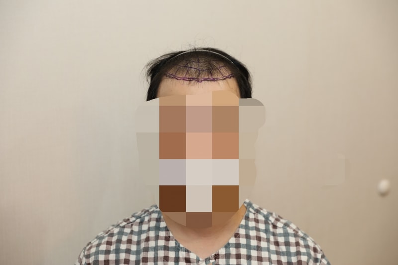 절개 5000모 모발이식 후기입니다.