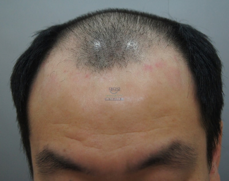 釜山FORHAIR 3000毛囊1周年了