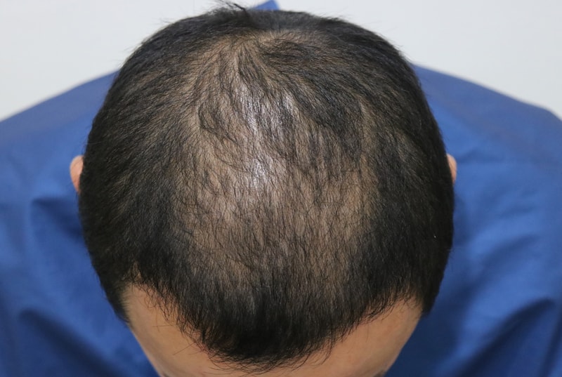 Day 2 of hair transplantation for crown hair loss