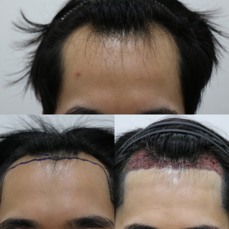 I got a hair transplant..Lol I hope you grow up like this