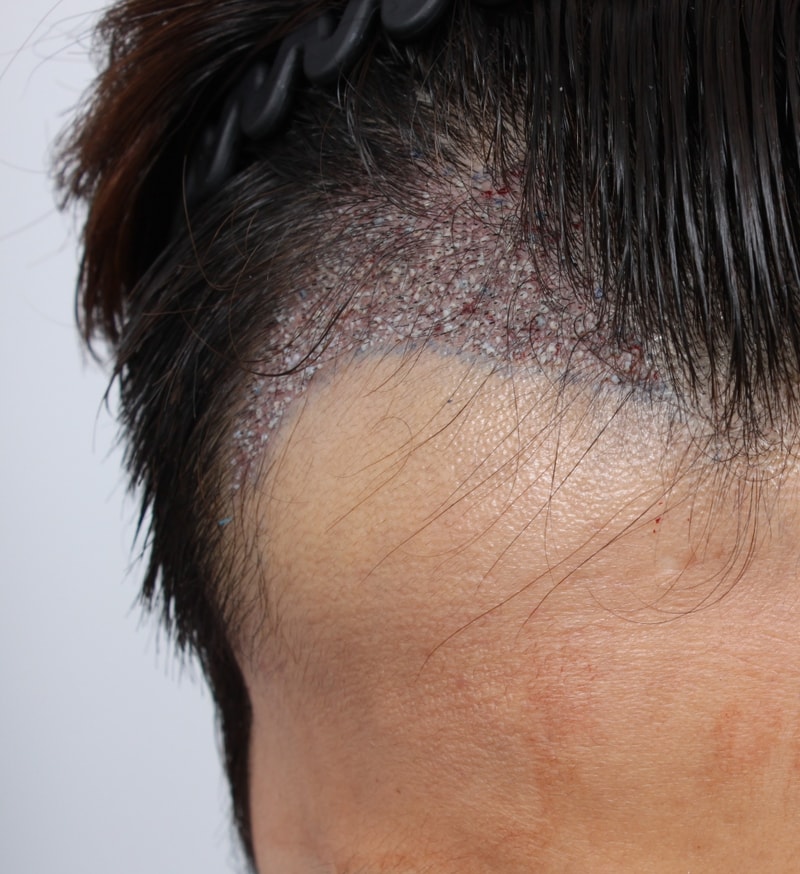 Finally, he had surgery in Busan's forehair