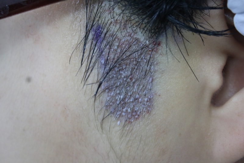 Gouretnaru M-shaped 1000 hair follicles