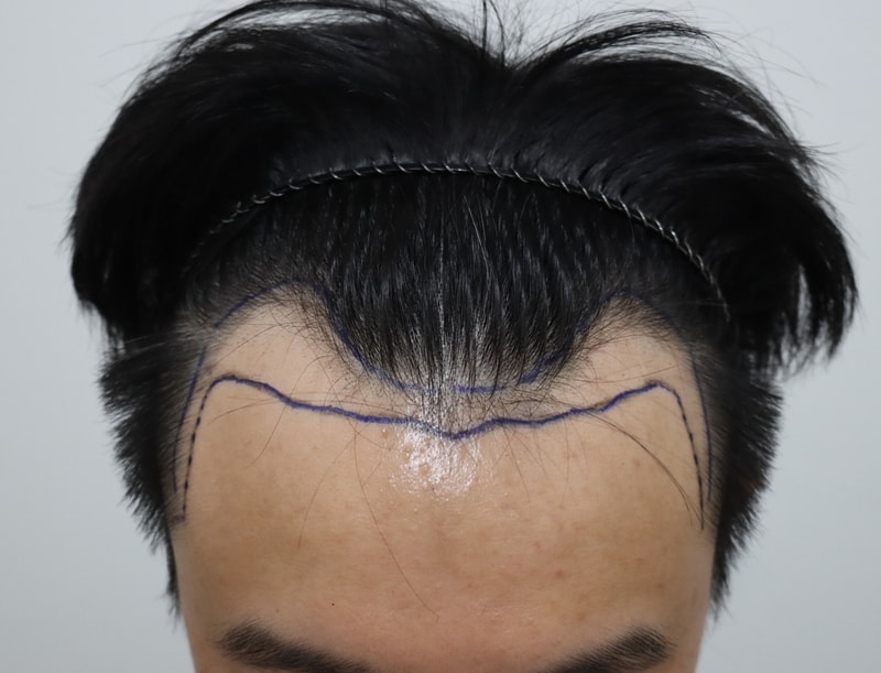 1. 수술 디자인.jpg