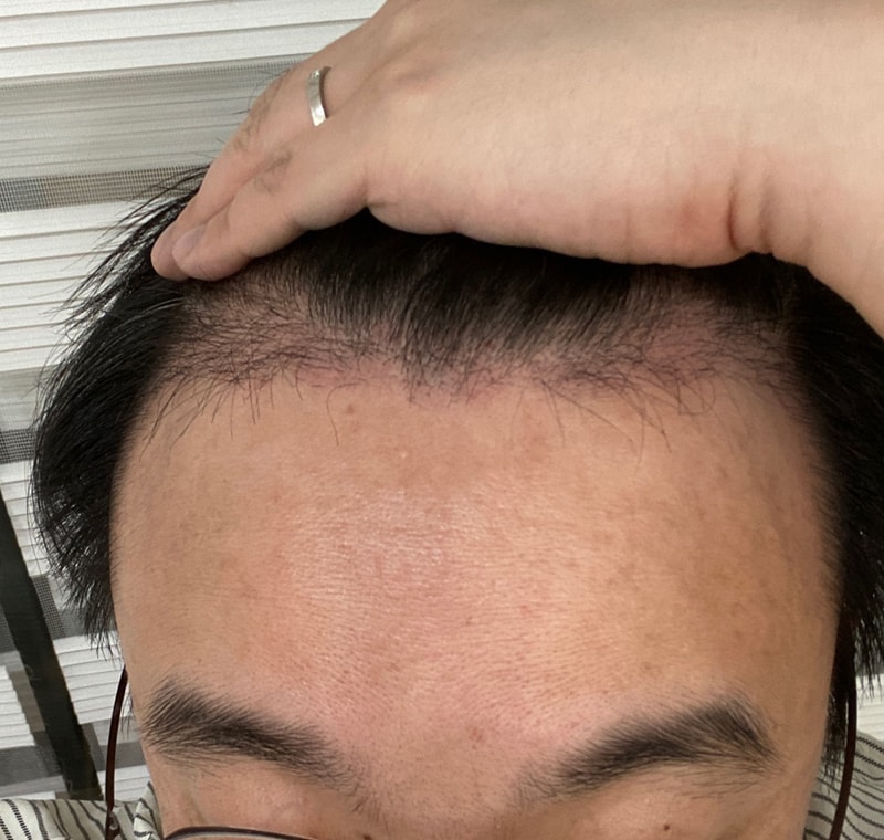 4. 수술 후 2개월.jpg