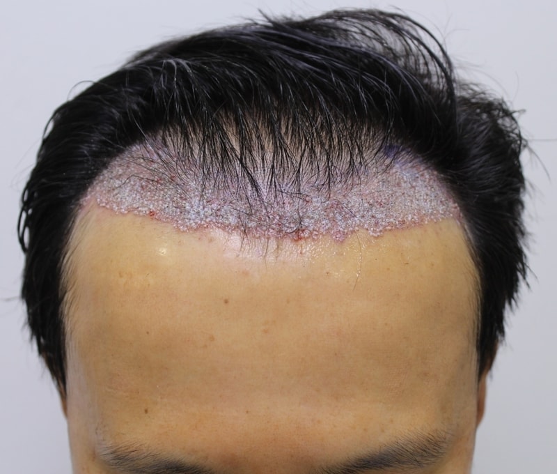 수술후1.JPG