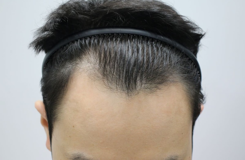 포헤어 서울점 민영기 원장님께 비대칭 m자탈모 비절개 모발이식 받았습니다