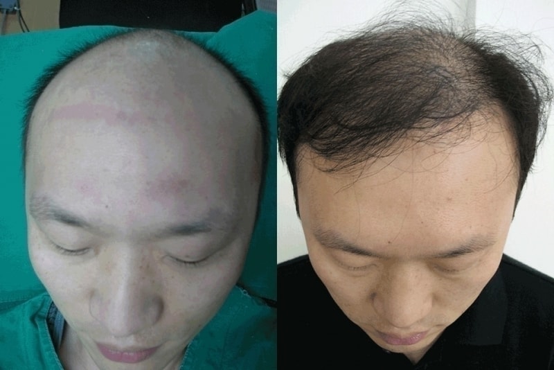 수술전과수술10개월후.gif