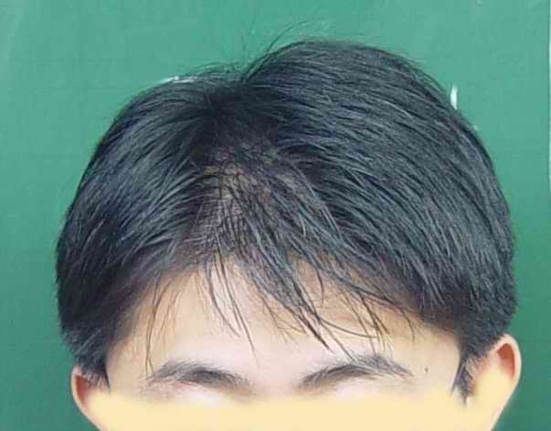 대머리2.jpg