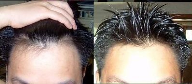 minoxidil3.JPG