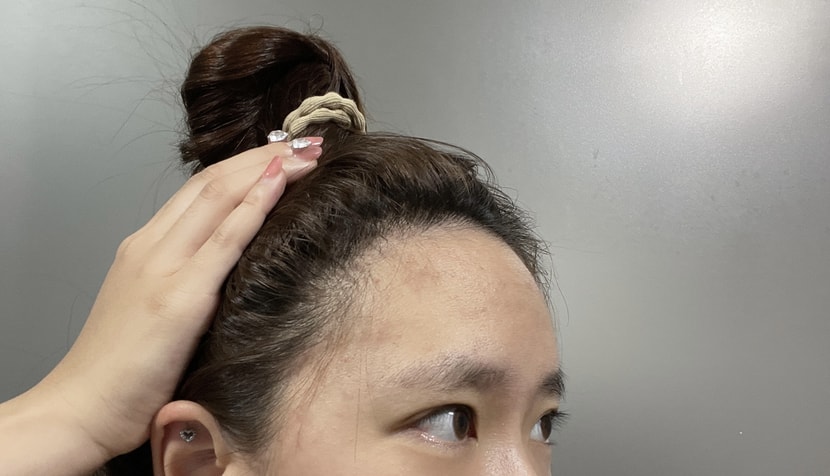 수술 후 1년 경과