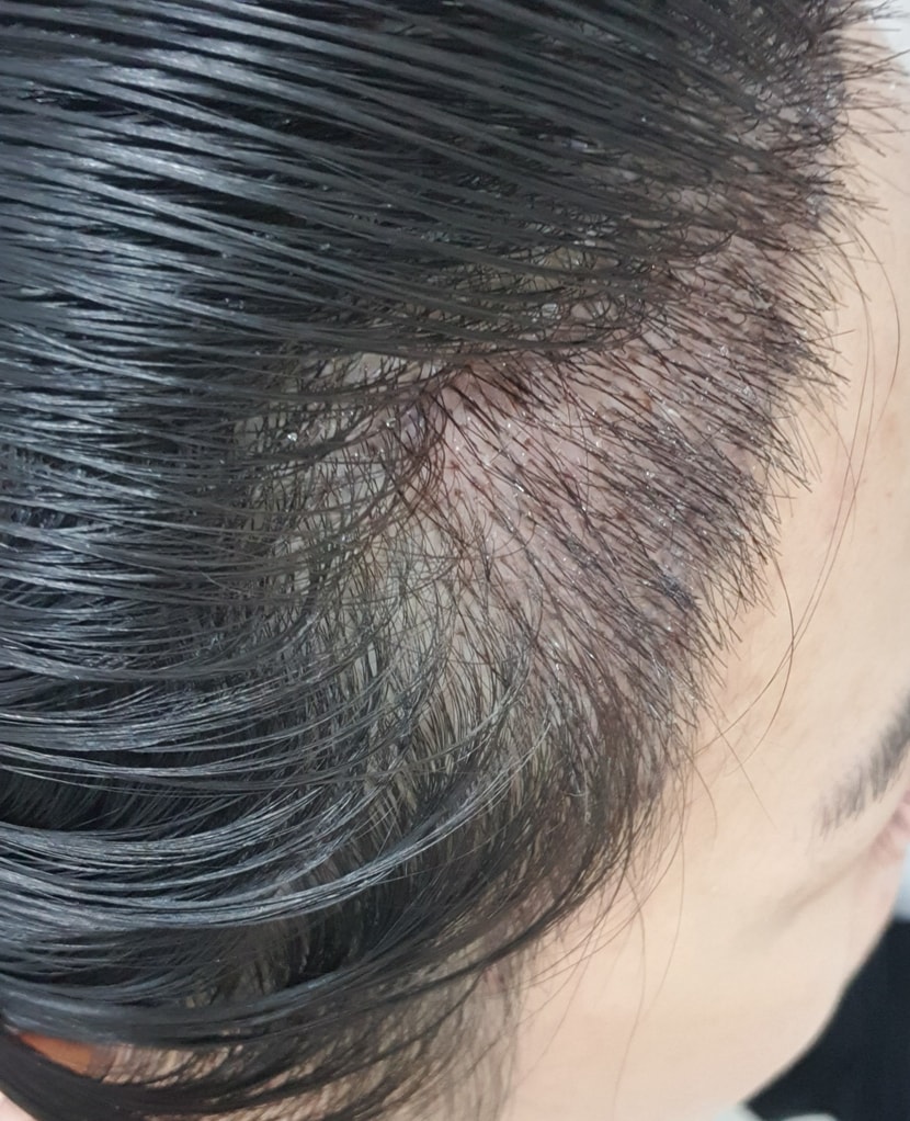 &lt;수술 4일후&gt;