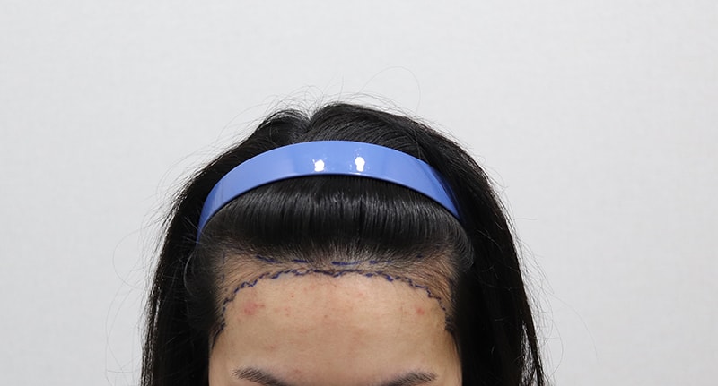 &lt;수술전 디자인&gt;