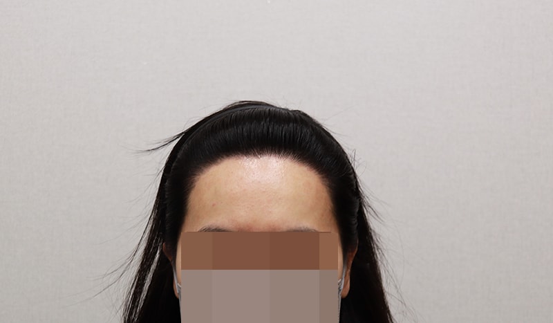 &lt;수술 1년 3개월 후&gt;