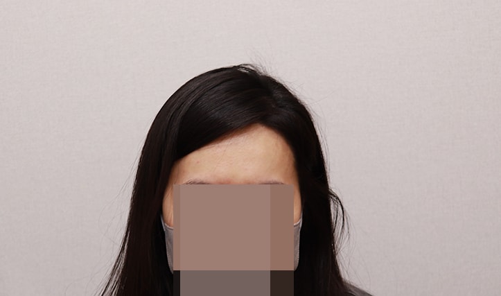 &lt;수술 1년 3개월 후&gt;