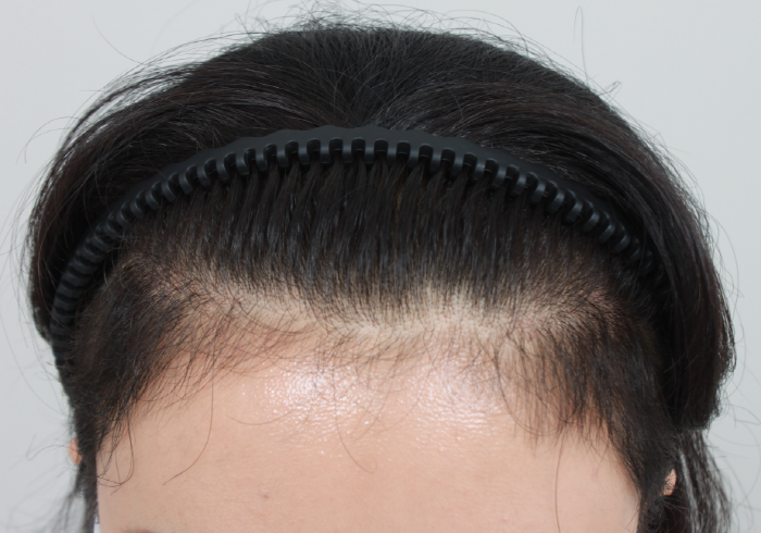 헤어라인 모발이식 후