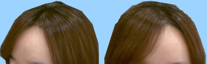 수술다음날~~ 머리감고!!..ㅋㅋ