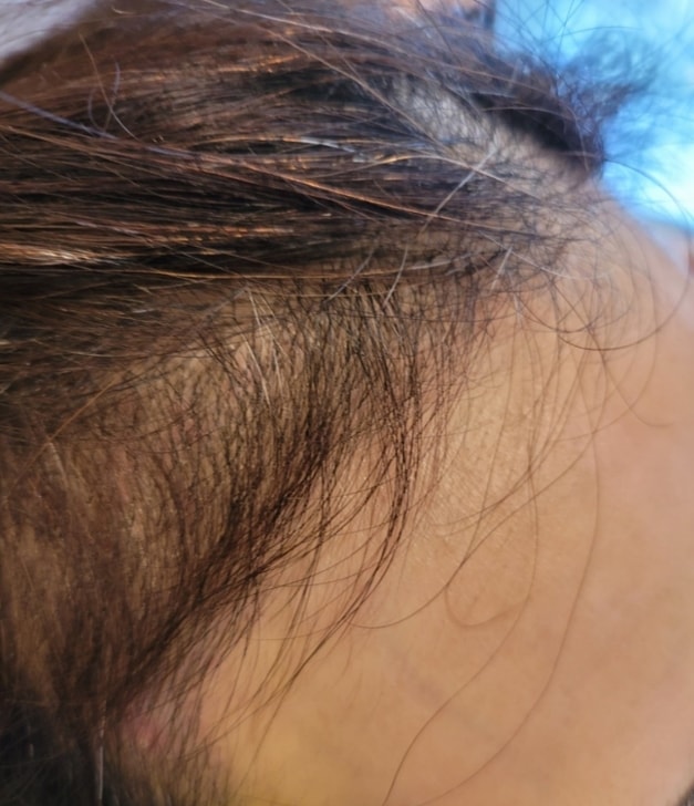 측면 수술 후 10일차