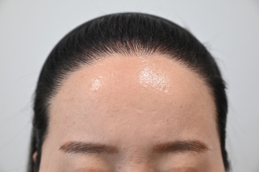 수술 후
