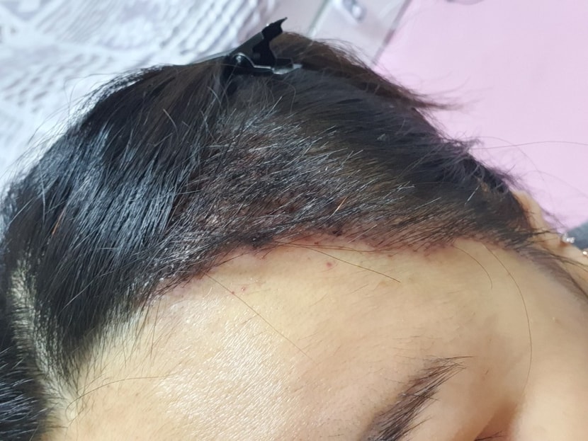 수술 2일차 2