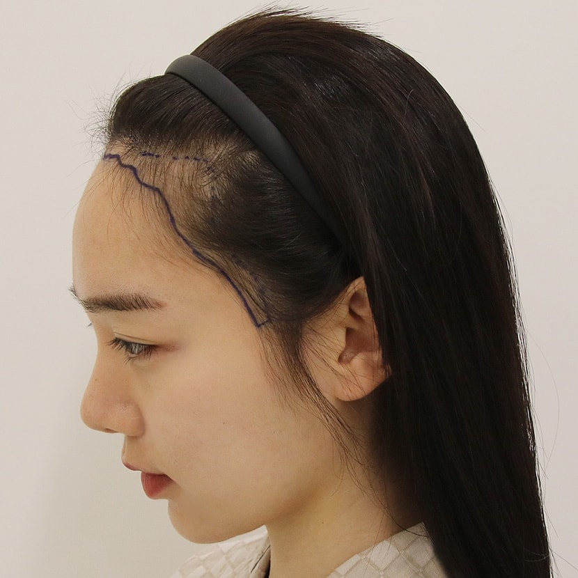 수술 전 디자인 옆