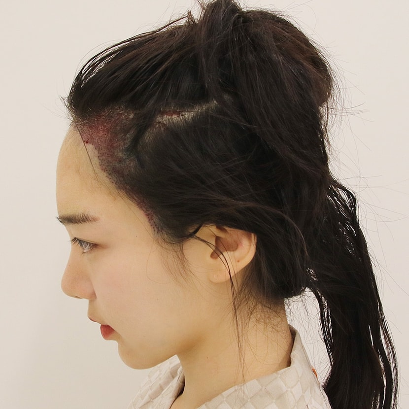 수술 후 당일 옆