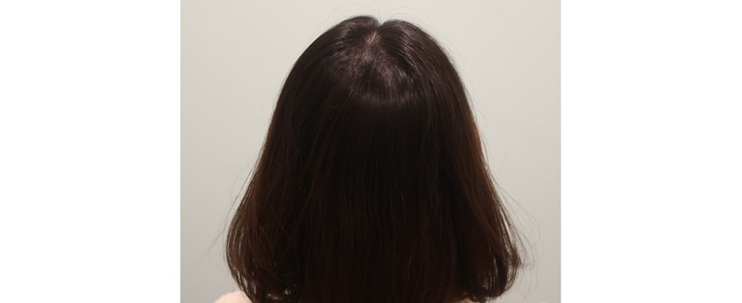 &lt;수술후 뒷모습♥&gt;