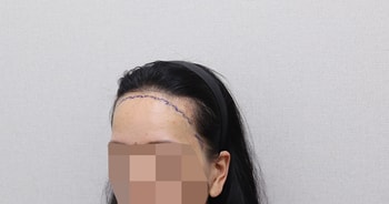 수술 전 디자인