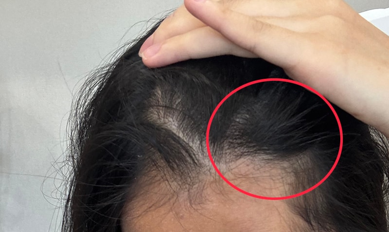 이쪽이 흉터부위예요 최근사진입니다