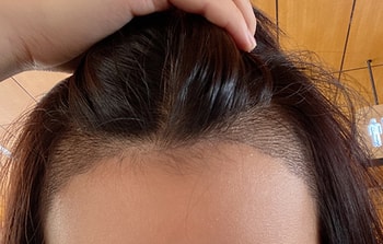 ﻿아까 낮에 찍은사진이에요 저는 각질이 1도 안생기네요 이제 일주일돼서 이식모는 조금 자랐는데 왜 때문에 각질이 안생길까용~~~??