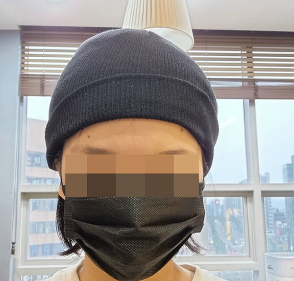 ﻿촬영끝나면 케어하는 방으로 들어가서 이렇게 비니를 씌워주세요~~~ㅎㅎ앞에서 찍어서 그렇지만 뒤에서 보면 붕대가 살짝 나와있어요 호텔은 가까운 리버사이드에서 묵었어요 방음문제가 있다고하는데 다행히 조용해서 잘잤어요