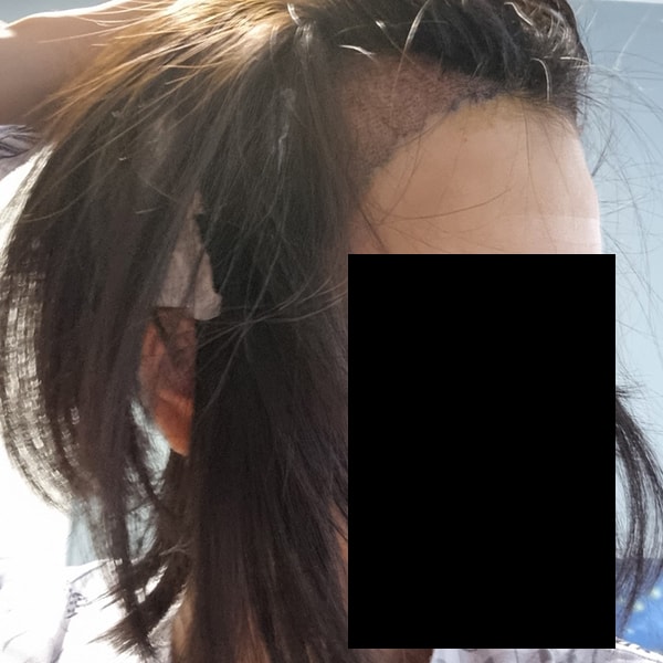 ﻿이식끝난후~~﻿수술다끝나고 옷갈아입기 전에 찍어봤어요~~수술다끝나면 채취할때 했던 붕대 떼고 연고를 떡칠하듯 발라주시더라구요 그러고 다시 붕대 붙여주세요ㅠㅠ 붕대뗄때 쓰라려요