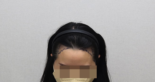 수술전 촬영