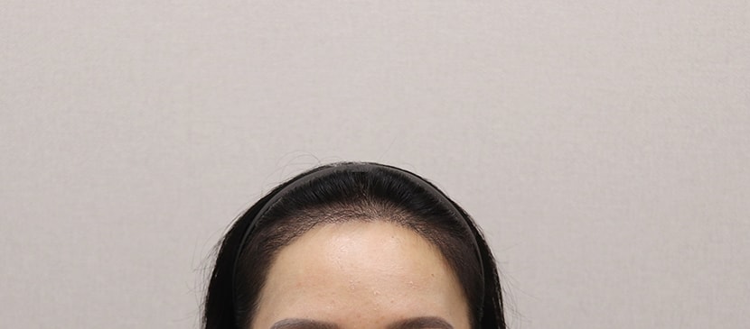 수술 4개월차, 병원에서 prp 받고서