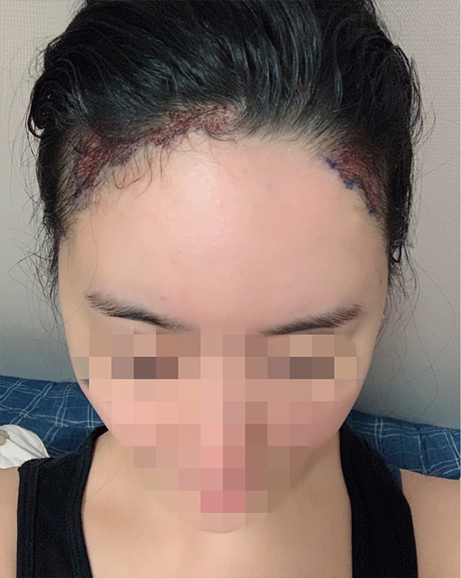 수술 받은 당일