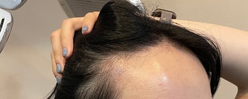 수술 2개월차 셀카