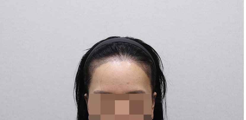 2주 케어 받은 후