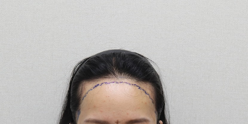 수술 전 디자인 