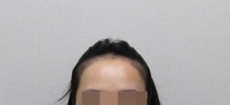 수술 3개월차 병원에서 찍은사진 정면