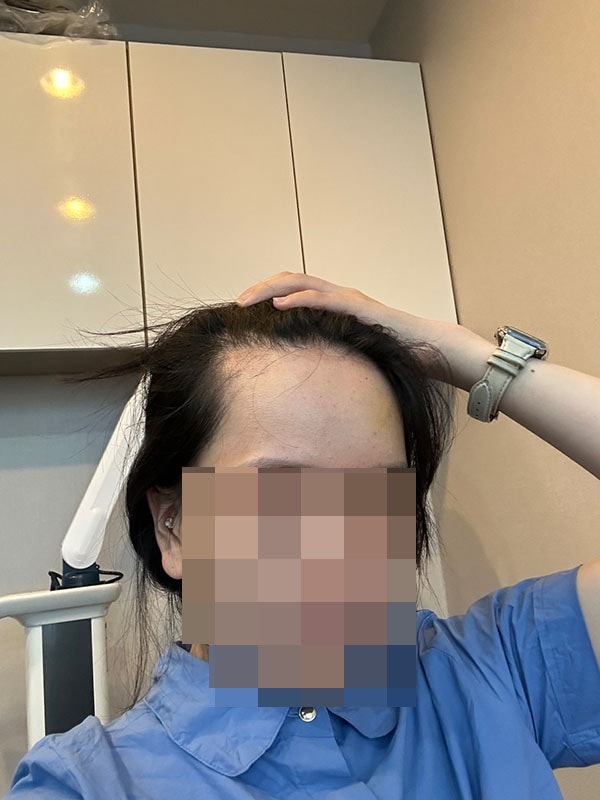 수술 1개월차 셀카