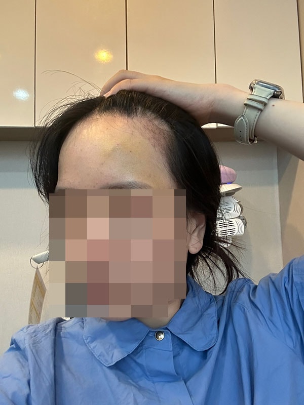 수술 1개월차 셀카