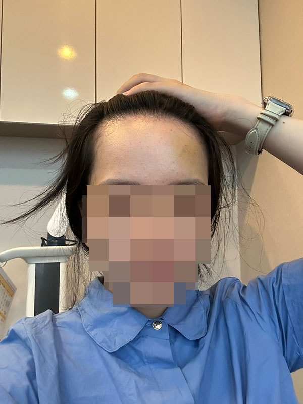 수술 1개월차 셀카