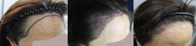 오른쪽 수술전-수술직후-6개월