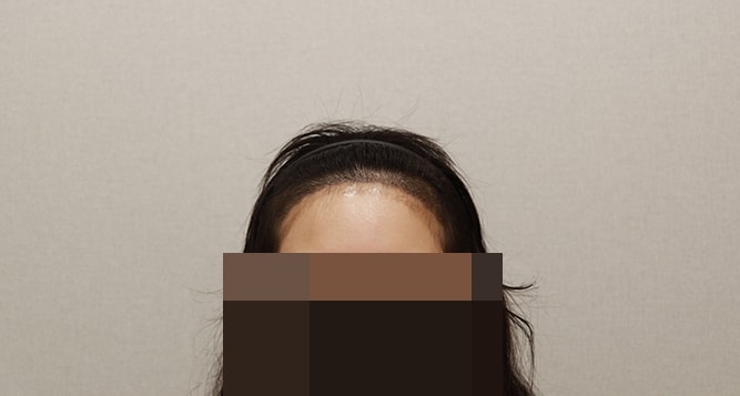 ﻿어제 각질케어 받고 찍었어용